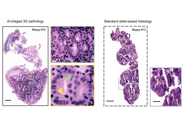 Imagen: Ejemplos de secciones de imágenes 3D de una biopsia muestran cómo la patología 3D (izquierda) mejoró el diagnóstico en comparación con los métodos bidimensionales convencionales (derecha) (Foto cortesía de la UW College of Engineering)